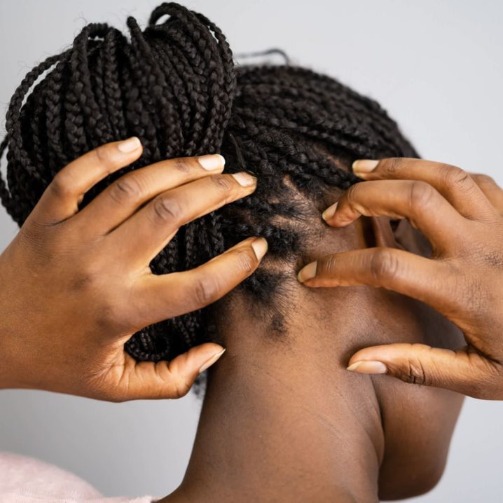 A flaky scalp isn't always caused by dandruff