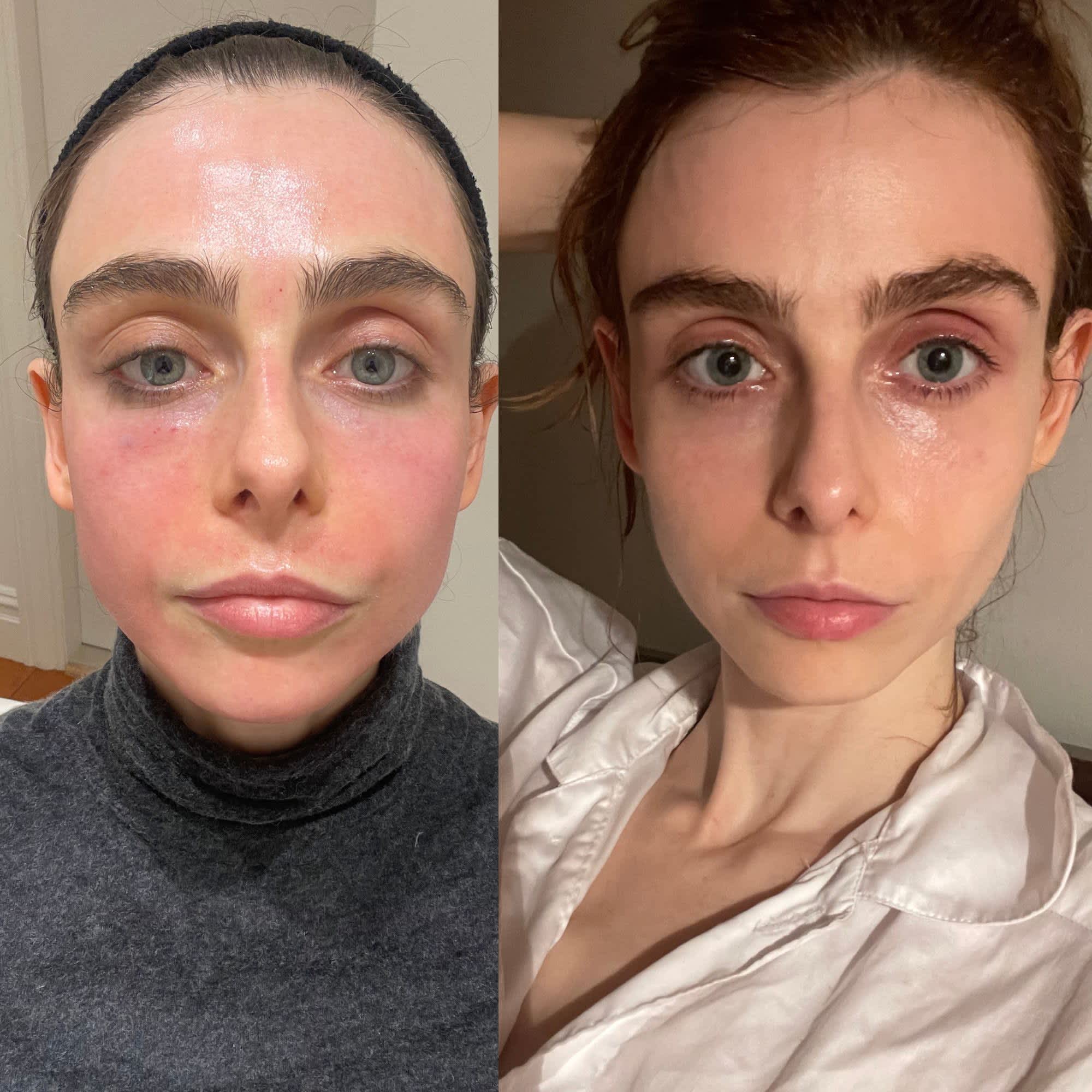 RF Microneedling Before and After