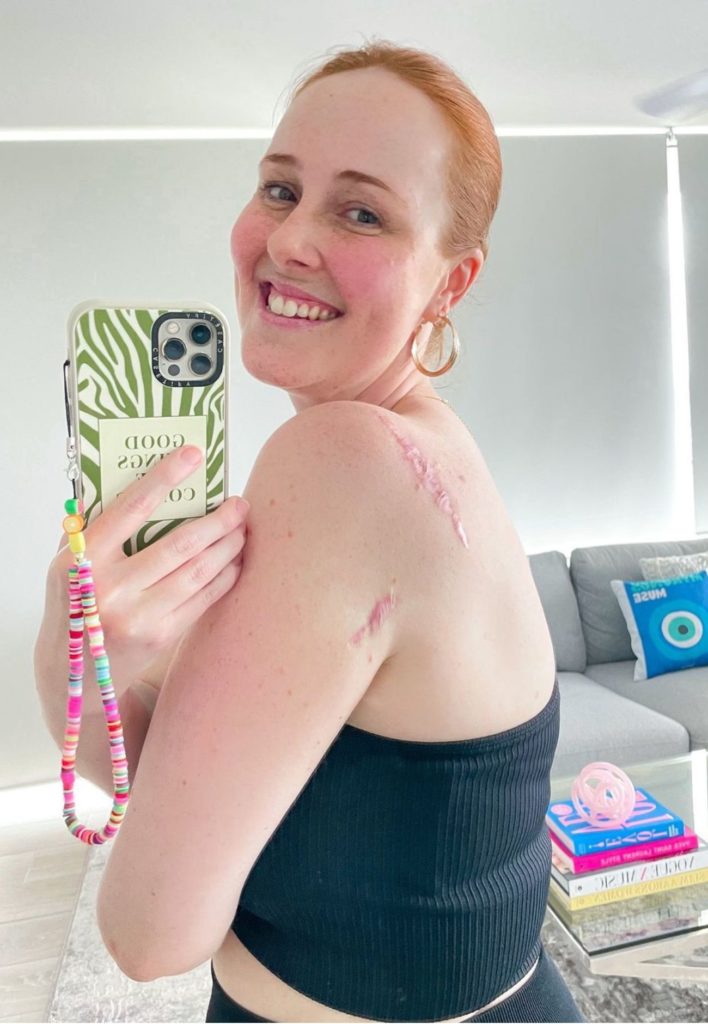 Courtne Mangan, four time cancer survivor shows the scar on her upper back, where a lump that turned out to be an aggressive melanoma was removed.