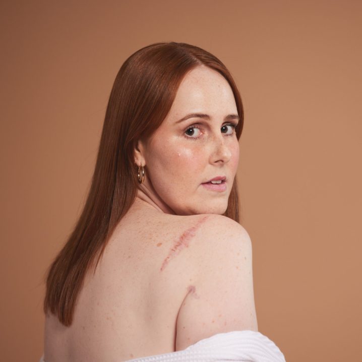 Courtney Mangan strips off to raise awareness about skin cancer checks