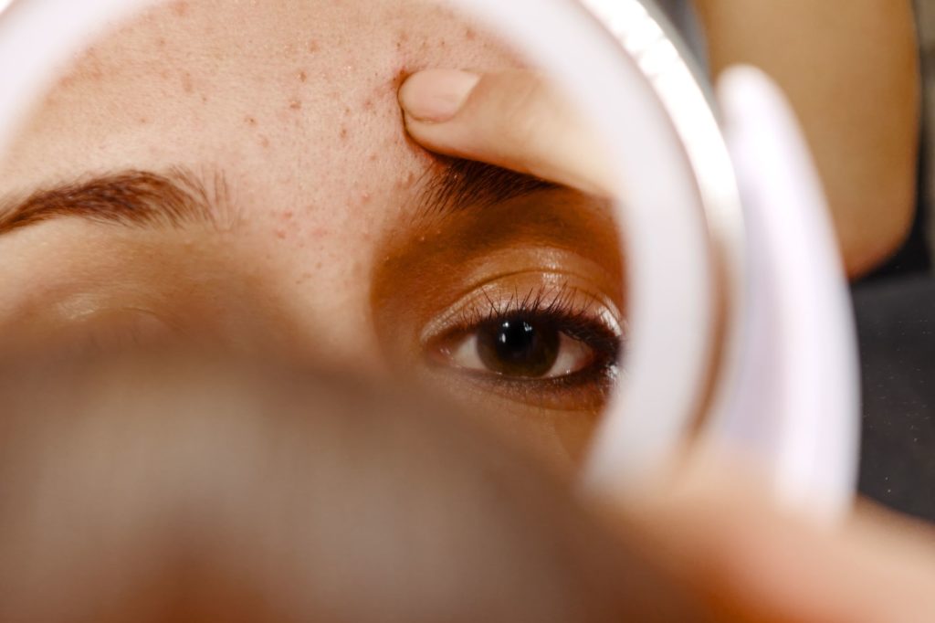 Best ingredients for acne-prone skin, woman looking at acne on her forehead 