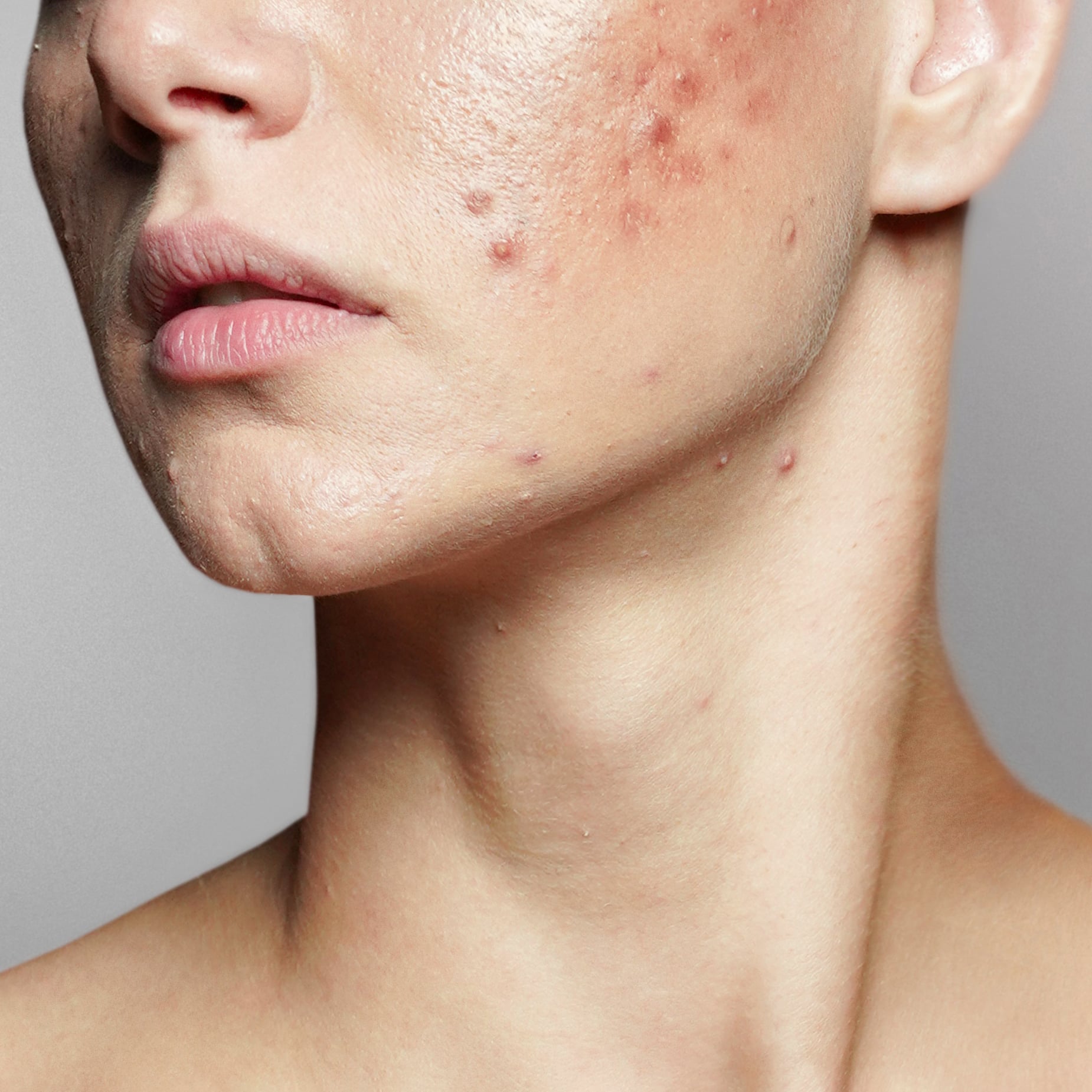 Poussée d’acné ?  Nous demandons aux experts les meilleurs traitements contre l’acné